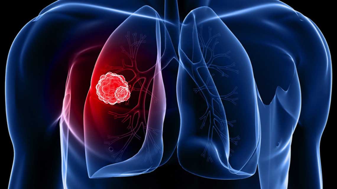 guarigioni dai tumori tumore al polmone