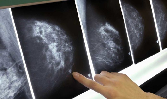 cancro al seno immunoterapia cura cancro